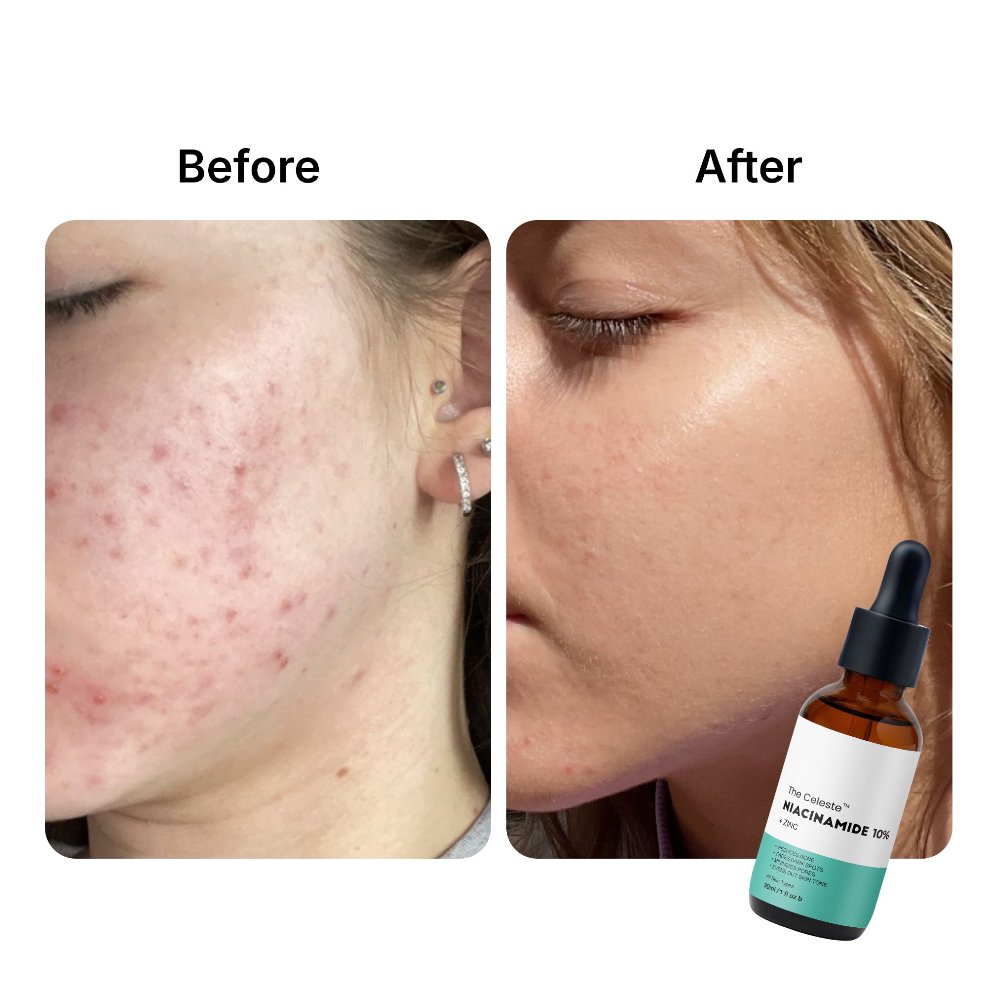 The-Celeste-Niacinamide-Serum-Before-After